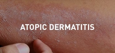 Skin of patient with atopic dermatitis