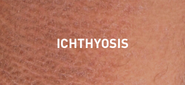 Skin of patient with ichthyosis