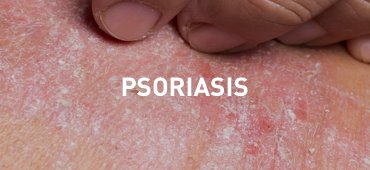 Skin of patient with psoriasis
