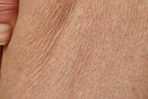 Xerosis Leg
