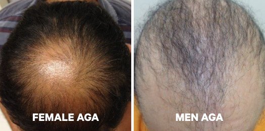 TREATMENT OF ANDROGENETIC ALOPECIA