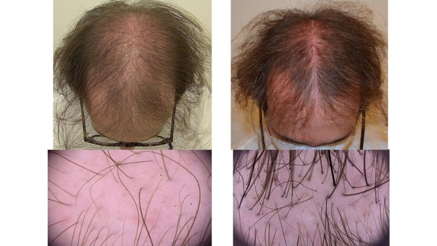 Alopecia