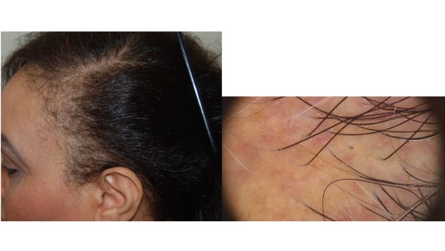 Scalp disorders