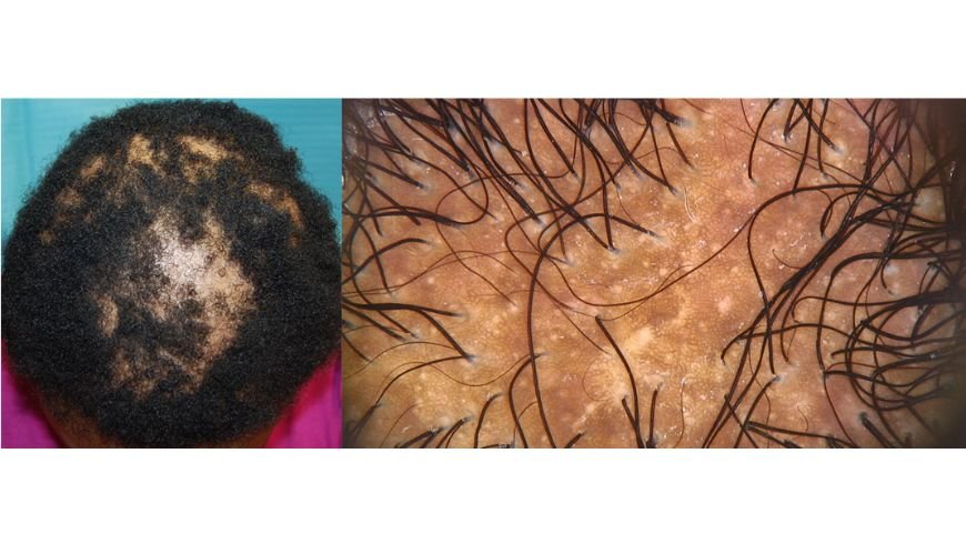 Scalp disorders