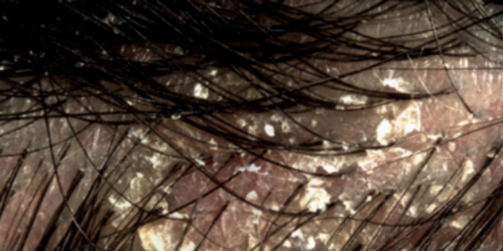 GB PSORIASIS