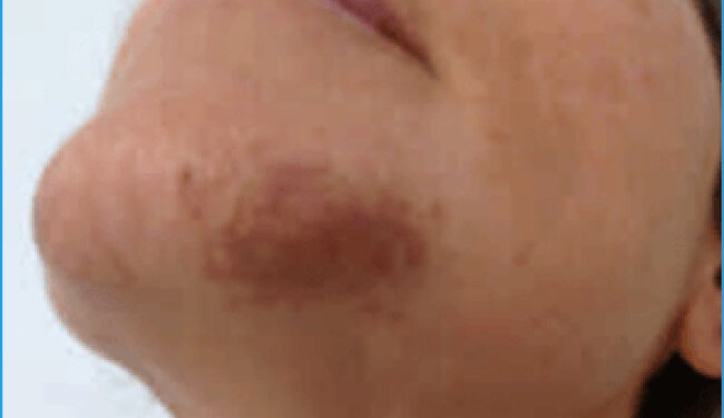 Acne and post-inflammatory hyperpigmentation