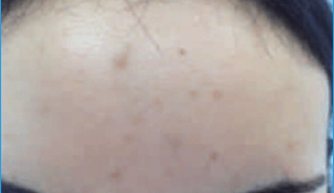 Acne and post-inflammatory hyperpigmentation
