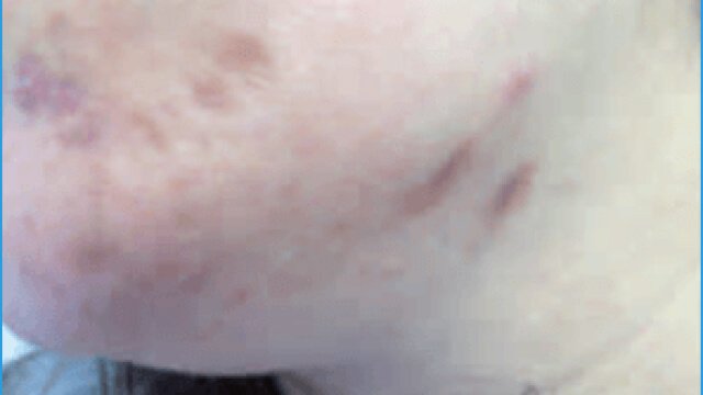 Acne and post-inflammatory hyperpigmentation