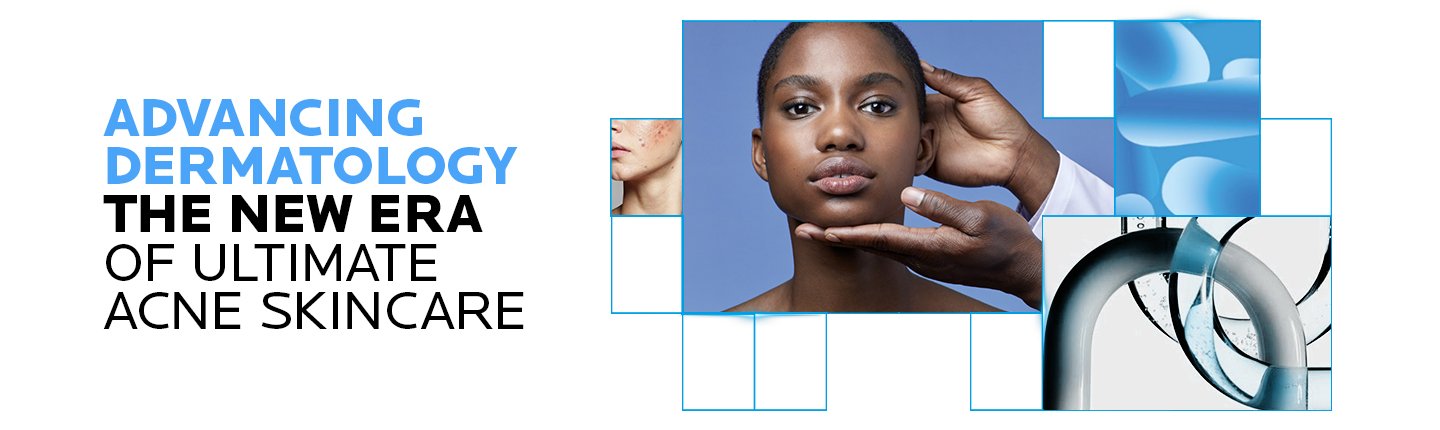 Acne consensus banner