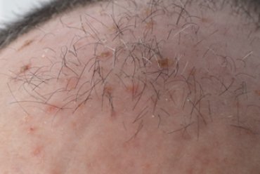Actinic keratosis: diagnostic and therapeutic situation
