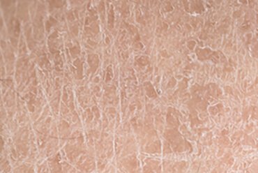 Adjunctive therapy for acne in daily practice
