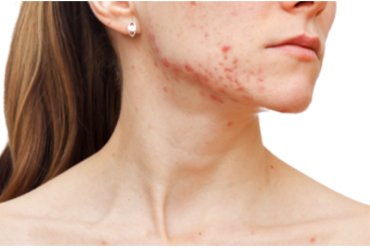 Adult Female Acne: latest scientific information
