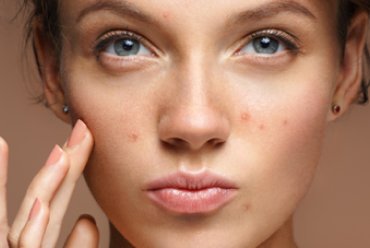 Adult Female Acne: latest scientific information