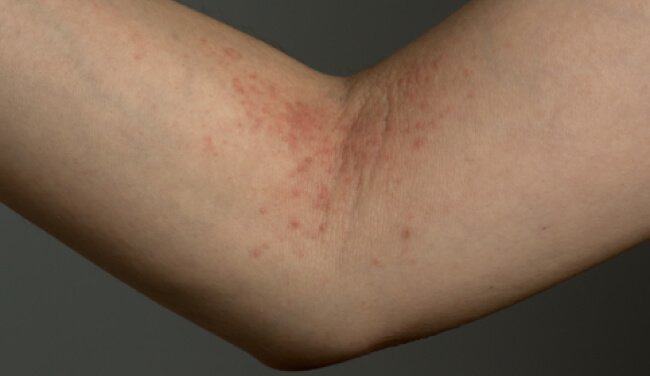 Benefits of scoring atopic dermatitis