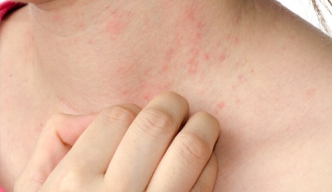 Benefits of scoring atopic dermatitis