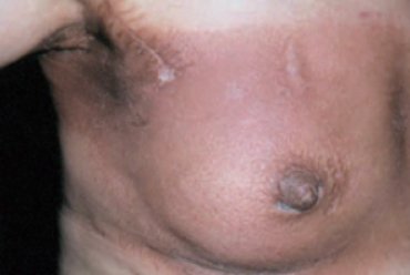 Cutaneous impact of oncology treatments