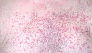 Cutaneous impact of oncology treatments