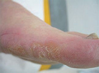 Cutaneous impact of oncology treatments