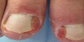 Cutaneous impact of oncology treatments