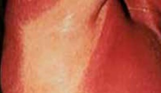 Cutaneous impact of oncology treatments