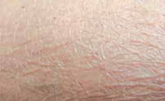 Cutaneous impact of oncology treatments