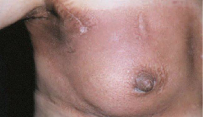 How to prevent or manage radiodermatitis