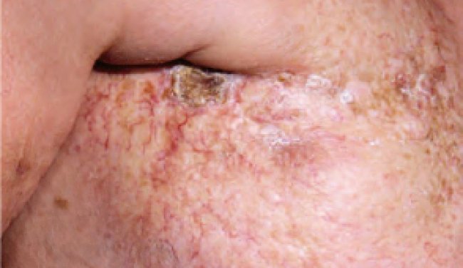 How to prevent or manage radiodermatitis