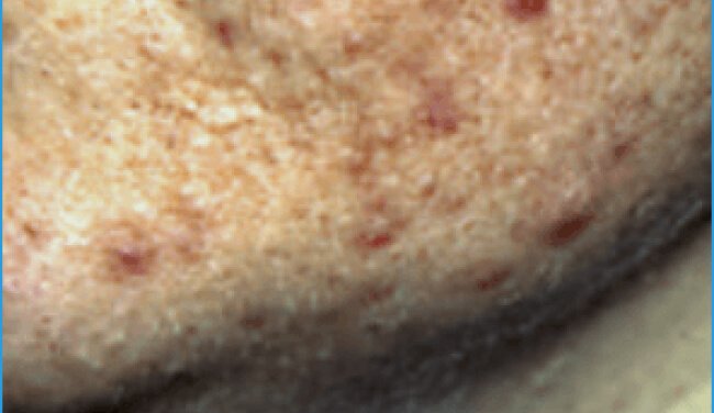 Acne in adult women
