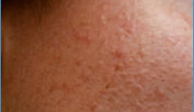 Acne in adult women
