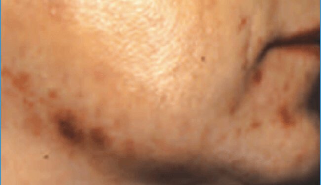 Acne in adult women