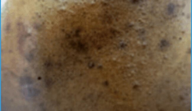 Acne in adult women