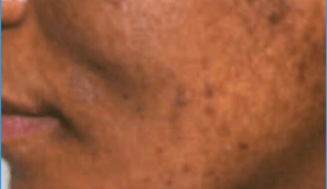 Acne in adult women