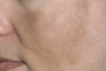 Impact of pregnancy on the skin