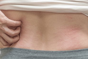 Impact of pregnancy on the skin