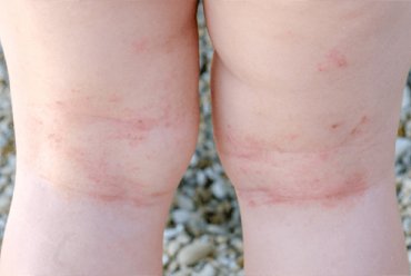 Prevent atopic dermatitis in at-risk children