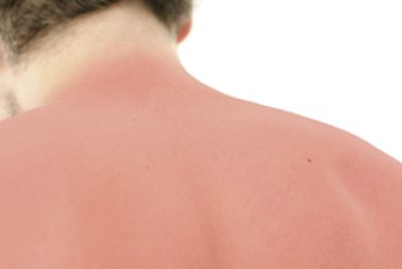 Long-term application of sunscreen could decrease risk of melanoma