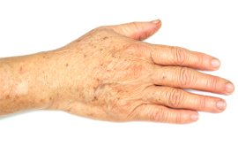 Pollution, a significant aggravating factor to skin aging