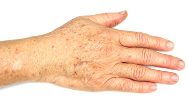 Pollution, a significant aggravating factor to skin aging