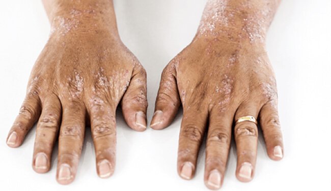 SCOREPI, a tool to aid in the clinical evaluation of irritative dermatitis