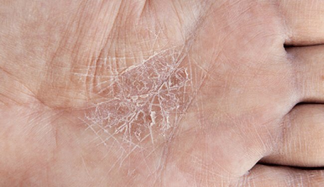 SCOREPI, a tool to aid in the clinical evaluation of irritative dermatitis