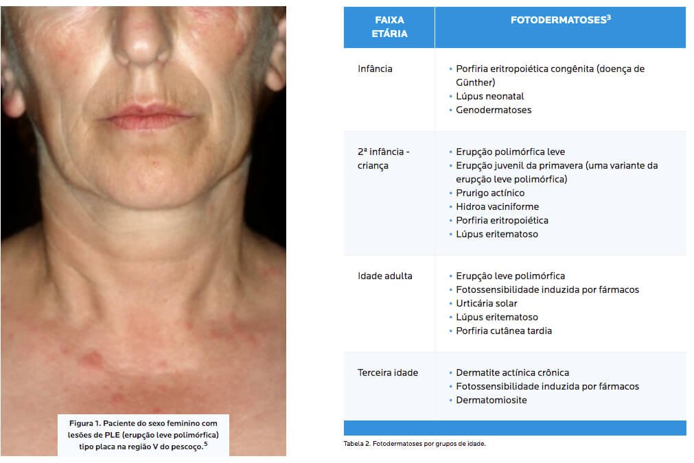 Fotodermatoses