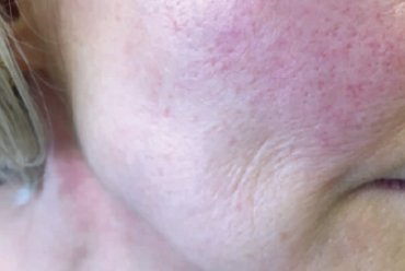 What are the causes of sensitive skin?