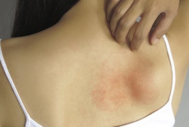 What is a Sensitive Skin?