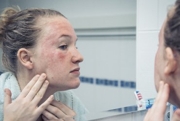 What is a Sensitive Skin?