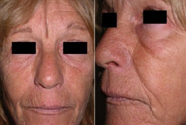 Who can be concerned by a sensitive skin?