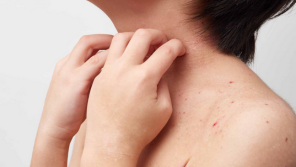 Adults with Atopic Dermatitis