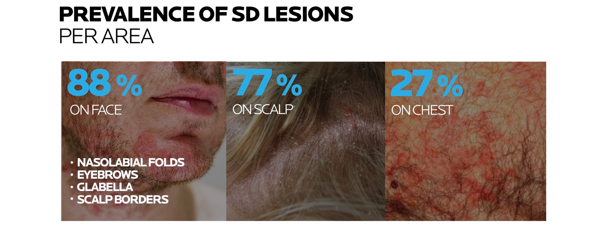 Seborrheic dermatitis chronic skin inflammation