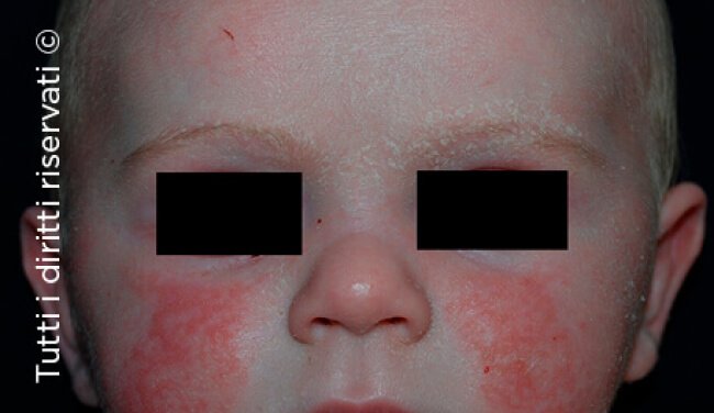 Atopic dermatitis