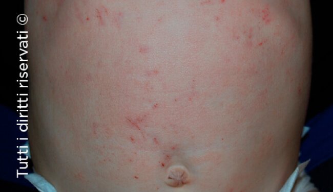 Atopic dermatitis