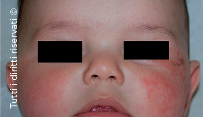 Atopic dermatitis